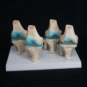 Анатомическая модель дегенеративного заболевания коленного сустава человека из ПВХ, учебные материалы по медицинской анатомии скелета